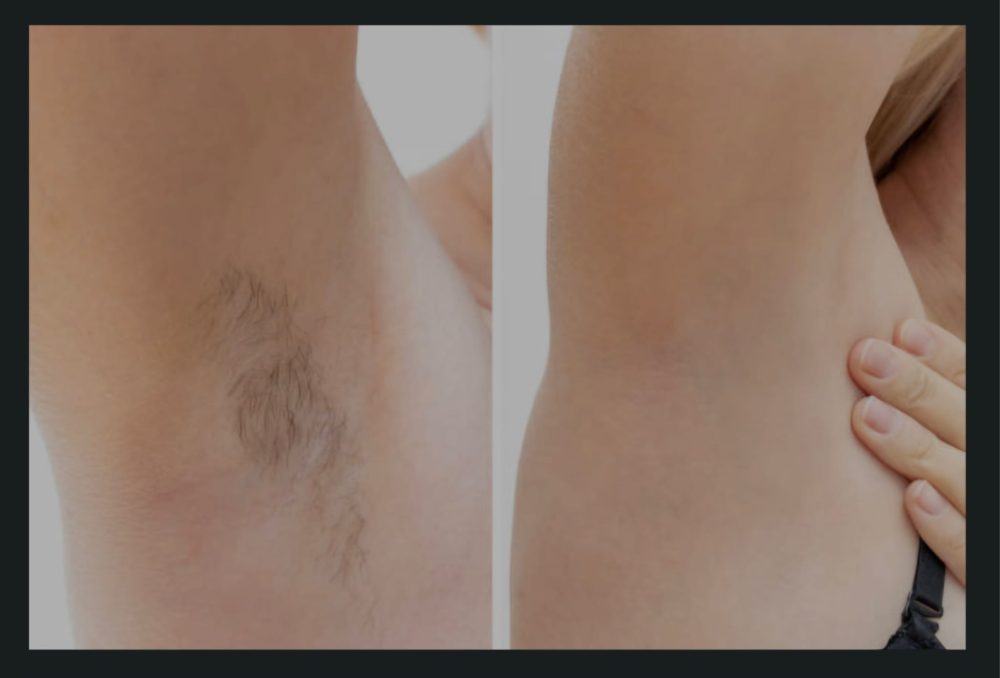 Ablauf einer Diodenlaser Haarentfernung bei DelMary Skin & Body