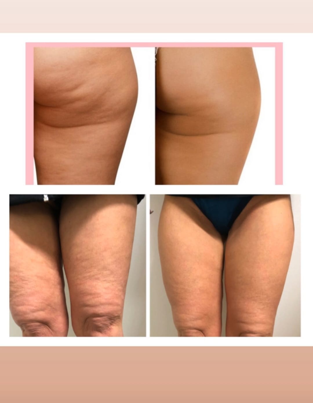 Kryolipolyse Vorher Nachher Beispiel 1 bei DelMary Skin Body