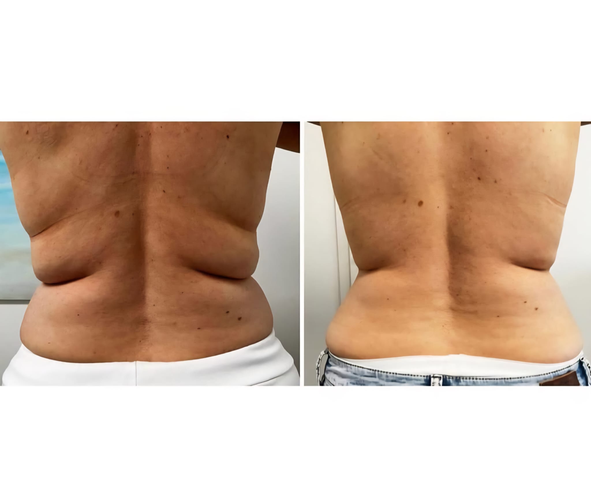 Kryolipolyse Behandlung Ergebnis DelMary Skin Body