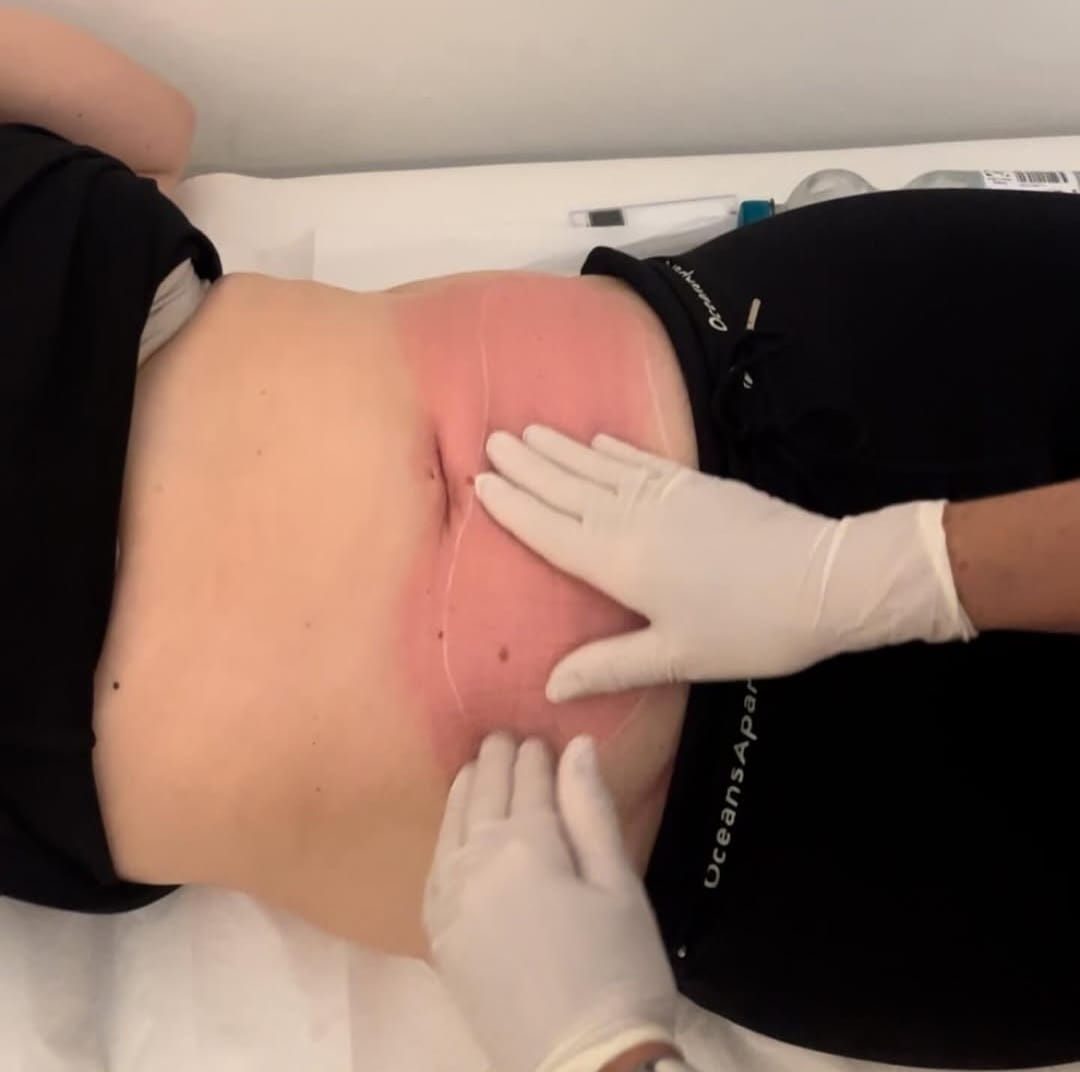 Kryolipolyse Ergebnis Beispiel 2 Hamburg