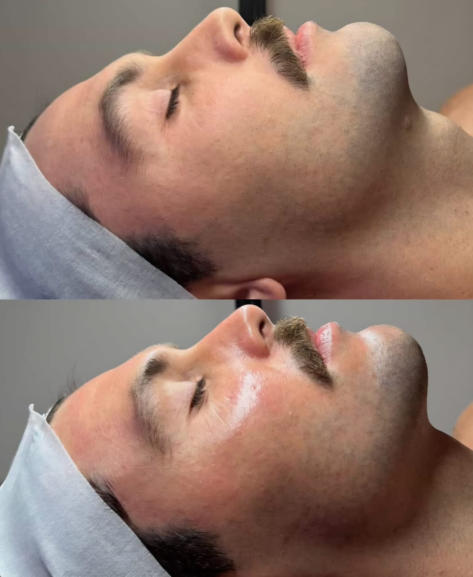 Microneedling-1