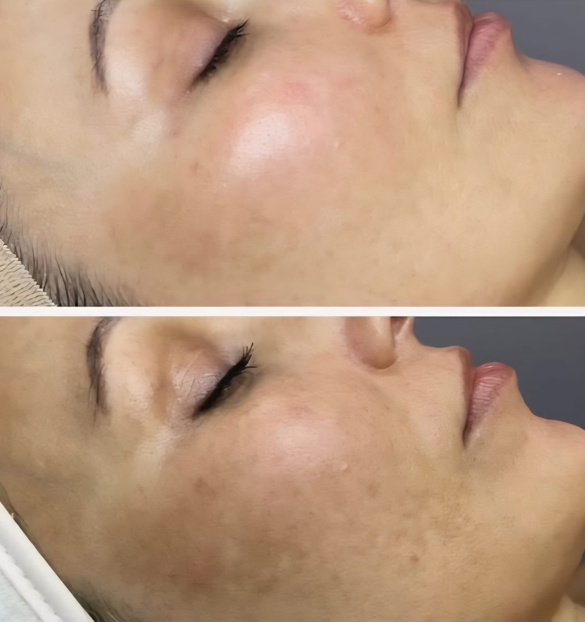 Microneedling-4