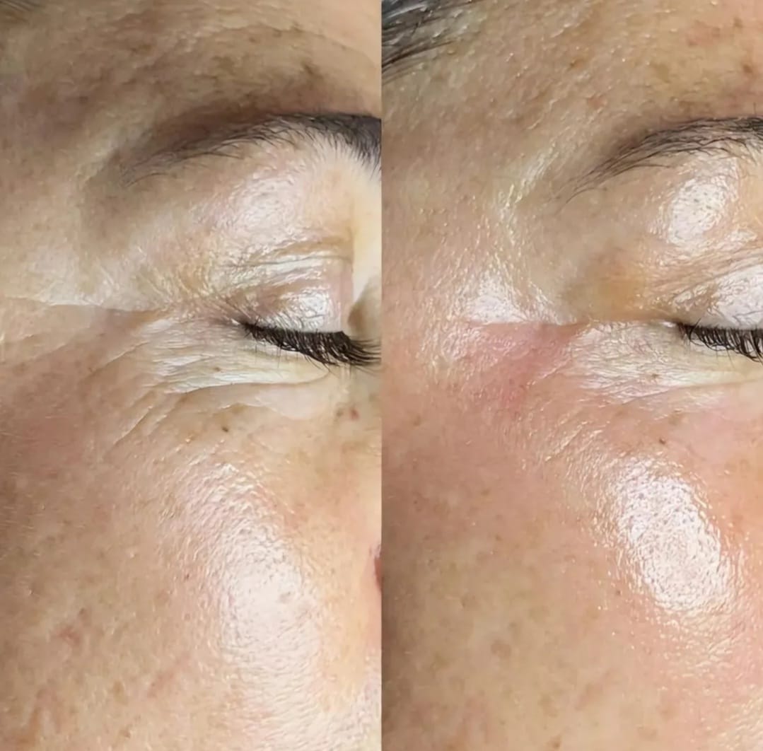 Microneedling