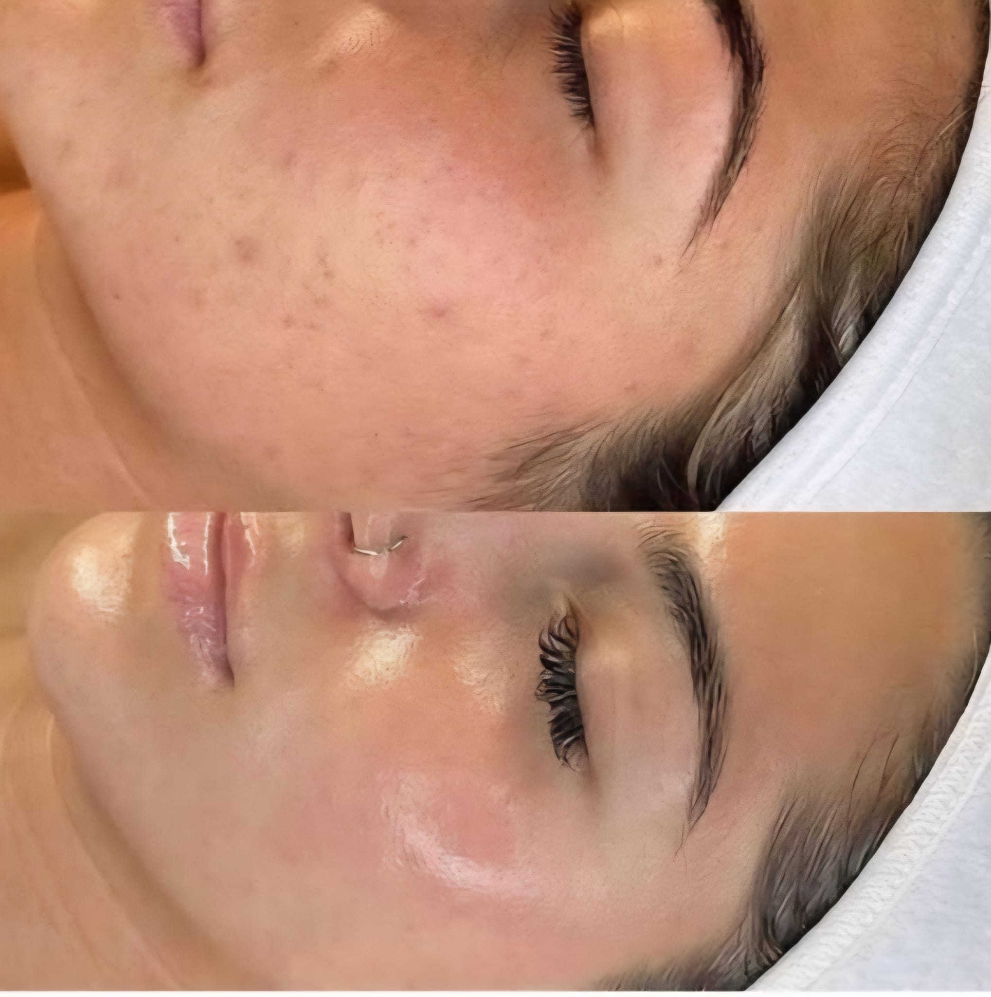 Hydrafacial Gesichtsbehandlung Ergebnis bei DelMary Skin Body