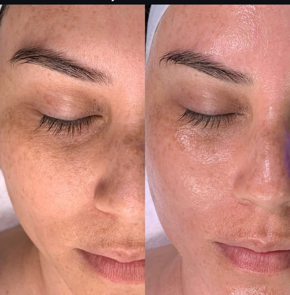 hydrafacial