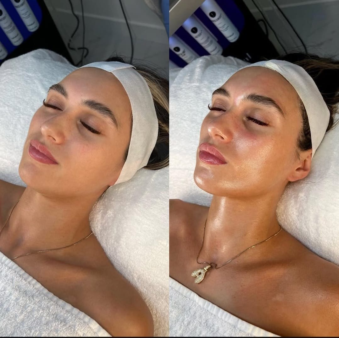 Hydrafacial Vorher Nachher Ergebnis in Hamburg Winterhude